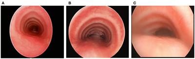 Tracheomalacia and Tracheobronchomalacia in Pediatrics: An Overview of Evaluation, Medical Management, and Surgical Treatment